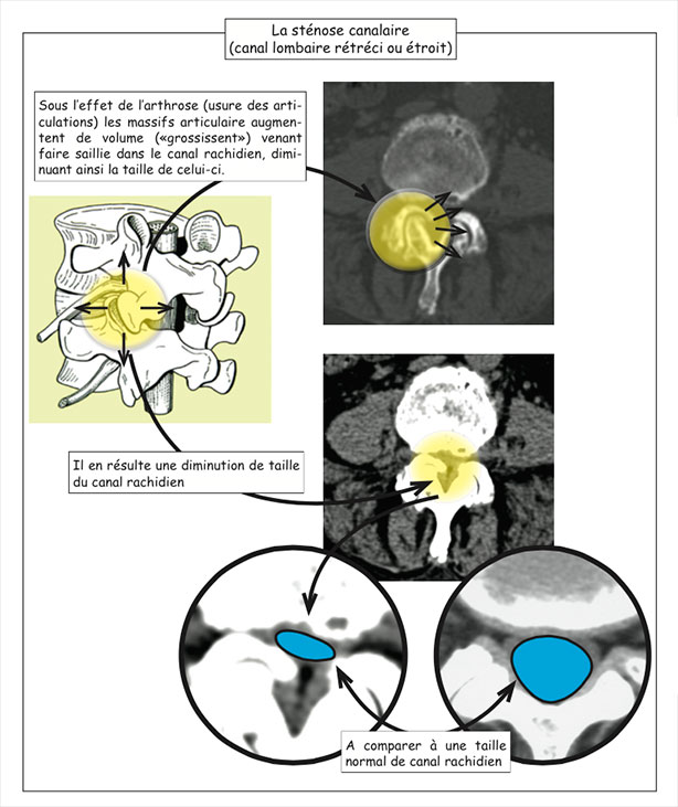 Sténose lombaire du canal rachidien