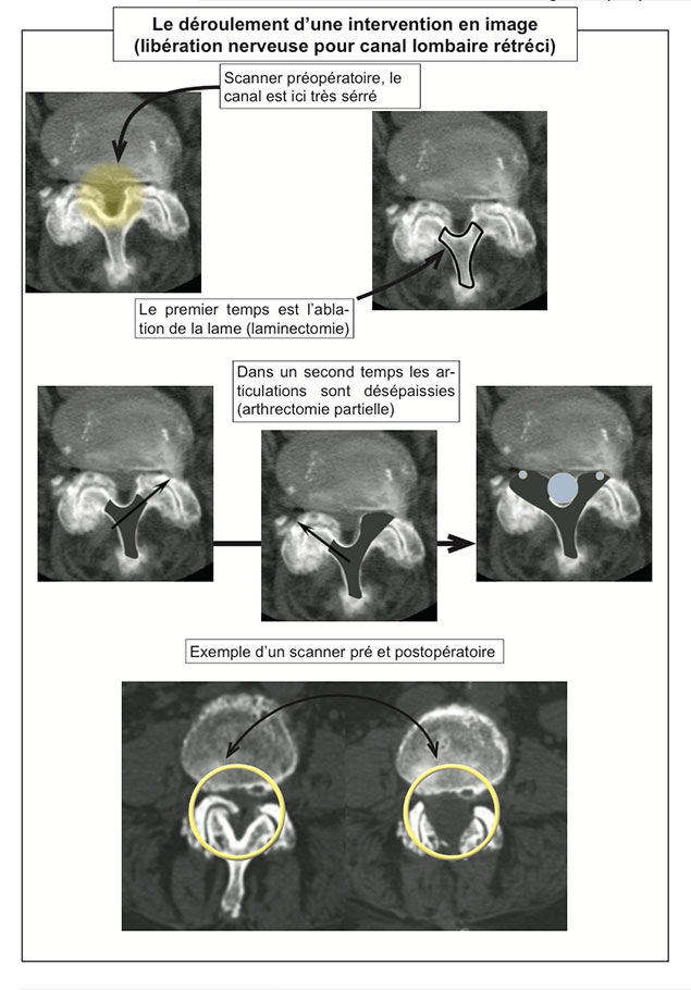 Sténose lombaire du canal rachidien